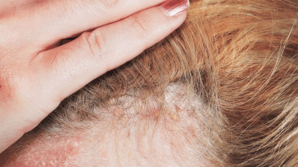 Stress Induced Psoriasis On Scalp